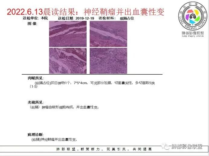 影像PPT - 【病例】后纵隔囊实性占位-16 影像PPT - 【病例】后纵隔囊实性占位-16