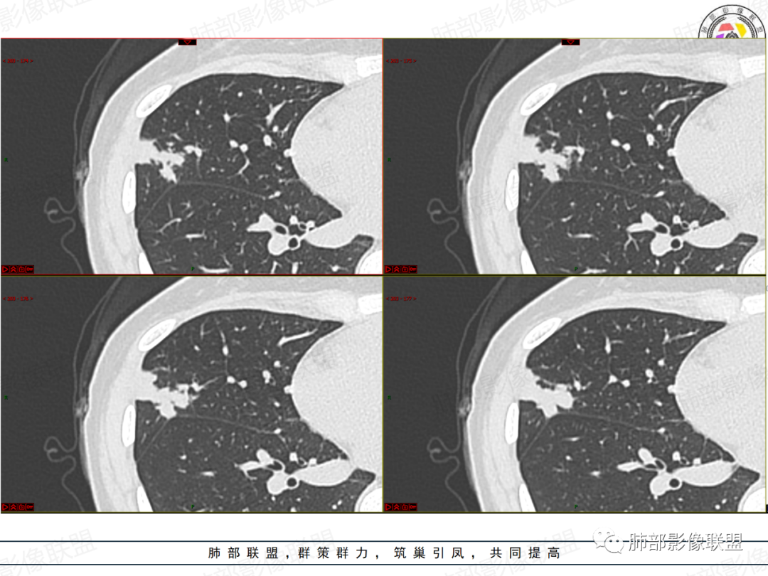影像PPT - 【病例】拐枣或树芽征的肺部病变-9 影像PPT - 【病例】拐枣或树芽征的肺部病变-9