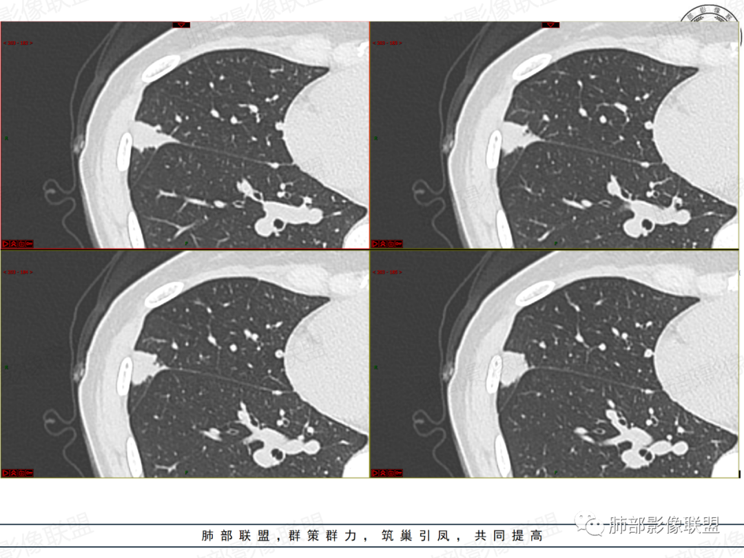 影像PPT - 【病例】拐枣或树芽征的肺部病变-11 影像PPT - 【病例】拐枣或树芽征的肺部病变-11