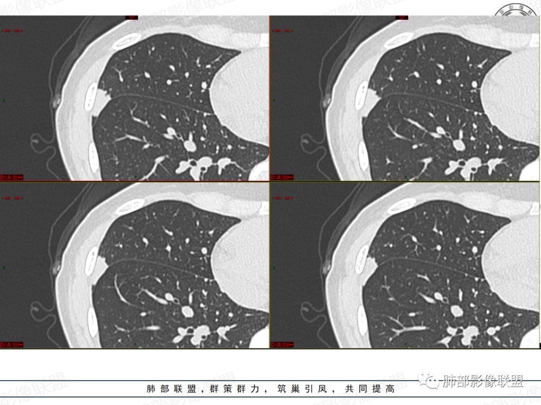 影像PPT - 【病例】拐枣或树芽征的肺部病变-13 影像PPT - 【病例】拐枣或树芽征的肺部病变-13