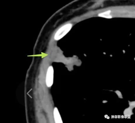 影像PPT - 【病例】拐枣或树芽征的肺部病变-33 影像PPT - 【病例】拐枣或树芽征的肺部病变-33