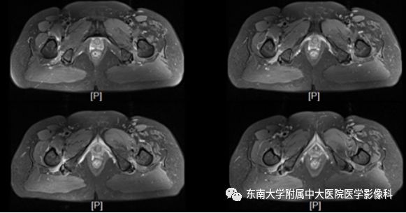 影像PPT - 【PPT】坐骨股骨撞击综合征-1