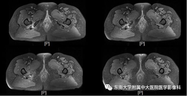 影像PPT - 【PPT】坐骨股骨撞击综合征-2