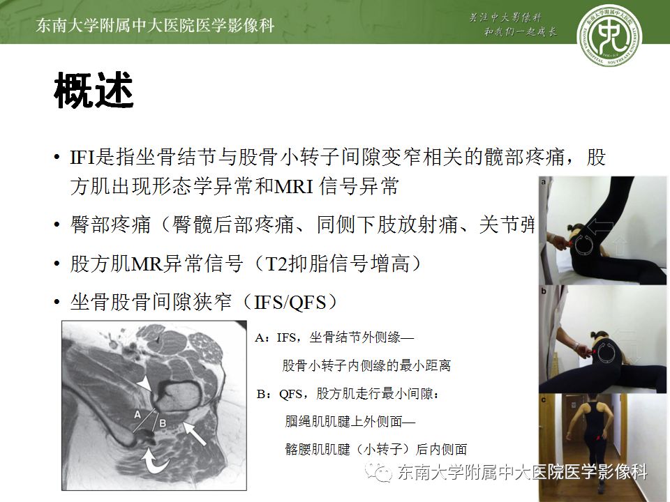 影像PPT - 【PPT】坐骨股骨撞击综合征-5
