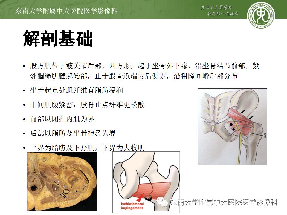 影像PPT - 【PPT】坐骨股骨撞击综合征-6