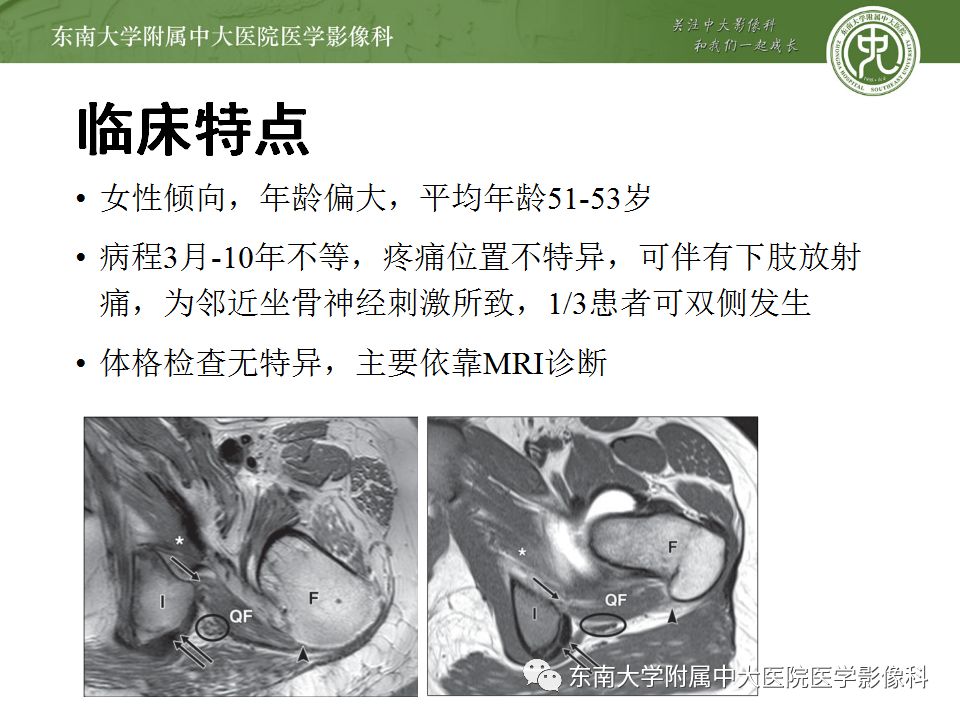 影像PPT - 【PPT】坐骨股骨撞击综合征-7