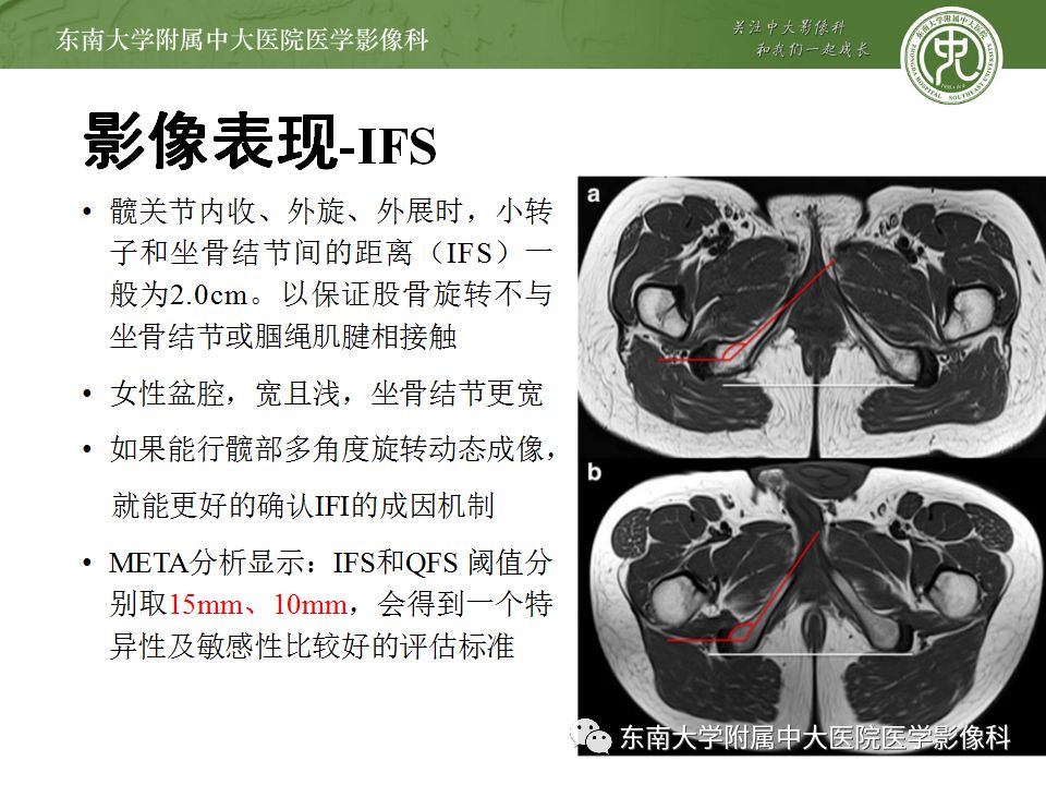 影像PPT - 【PPT】坐骨股骨撞击综合征-8