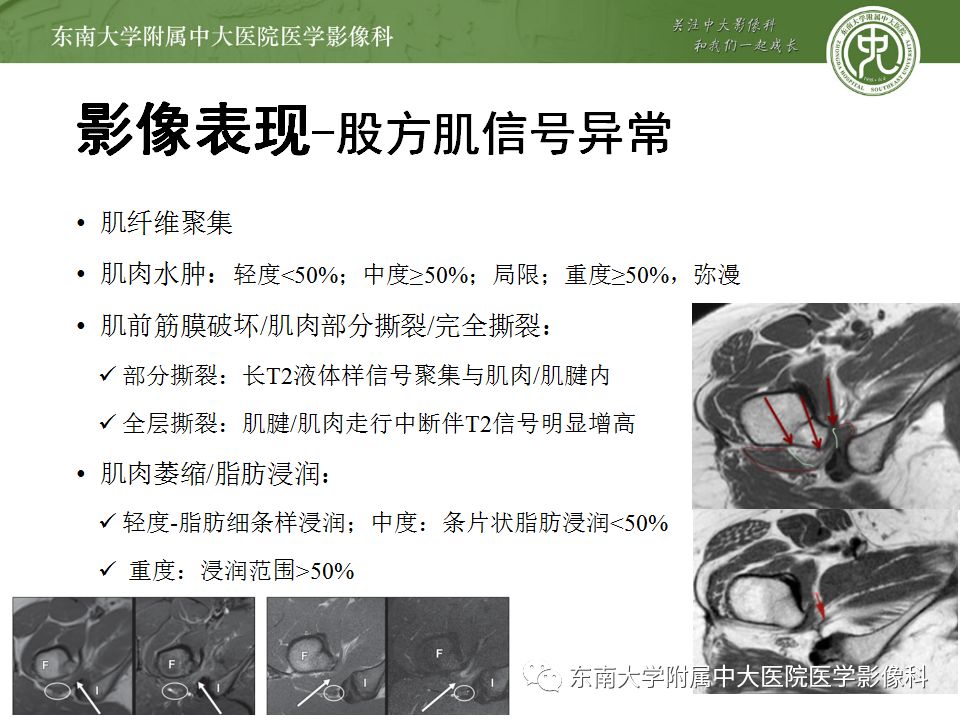 影像PPT - 【PPT】坐骨股骨撞击综合征-9