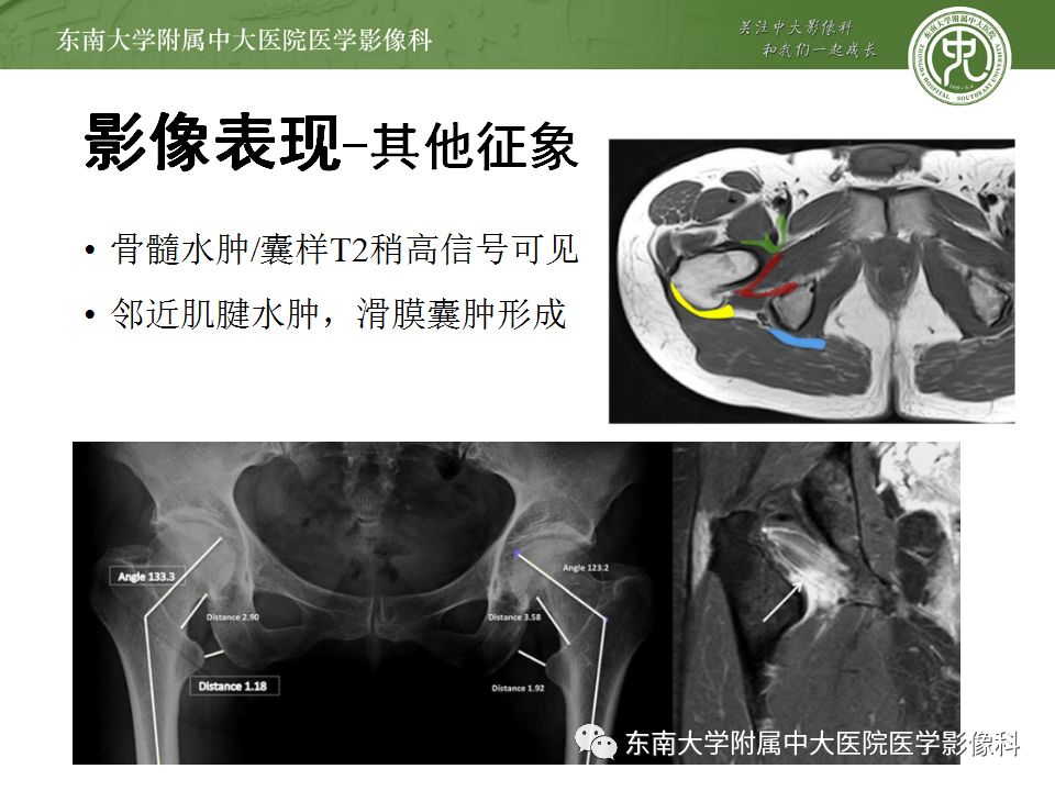 影像PPT - 【PPT】坐骨股骨撞击综合征-10