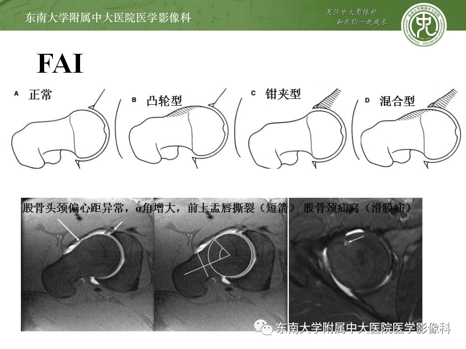 影像PPT - 【PPT】坐骨股骨撞击综合征-12