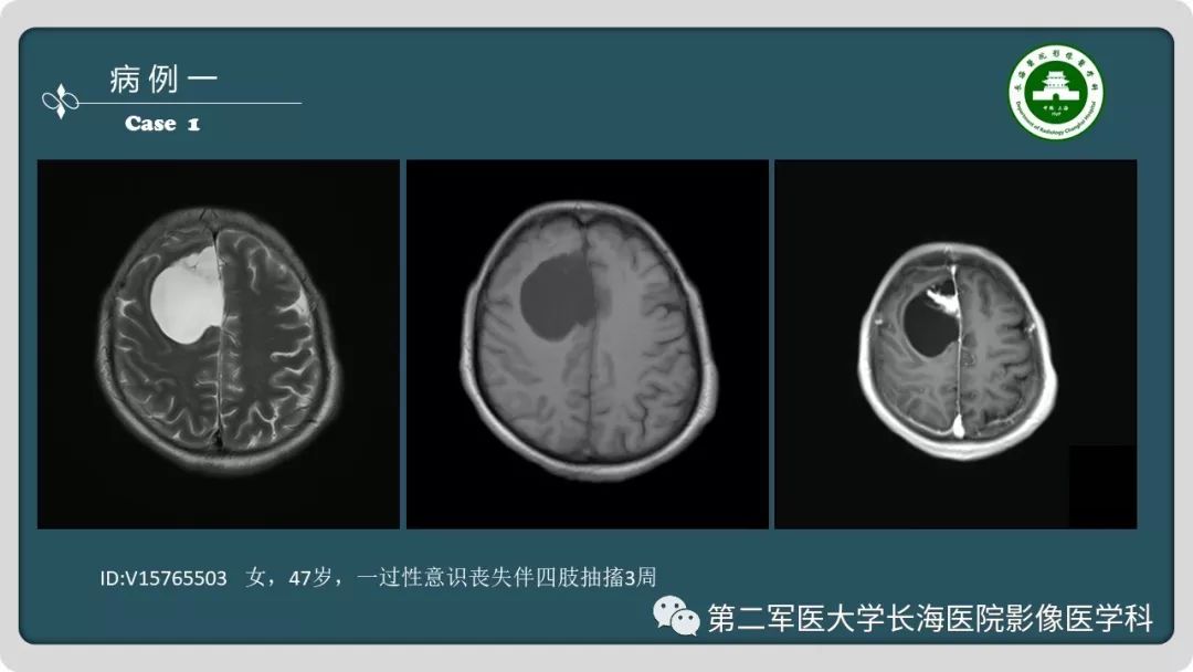 影像PPT - 【PPT】颅内囊性病变影像表现-2