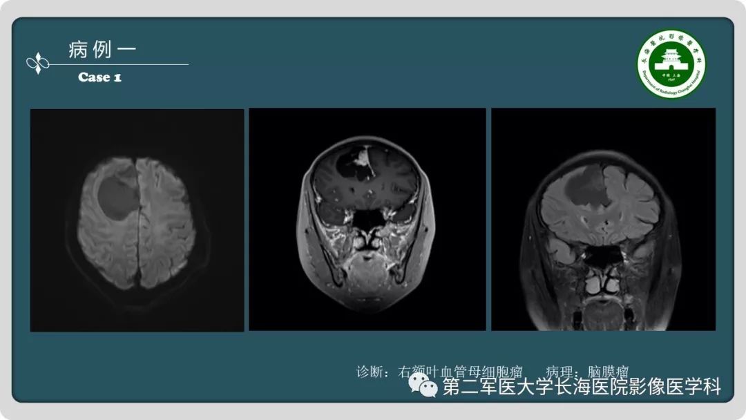 影像PPT - 【PPT】颅内囊性病变影像表现-3
