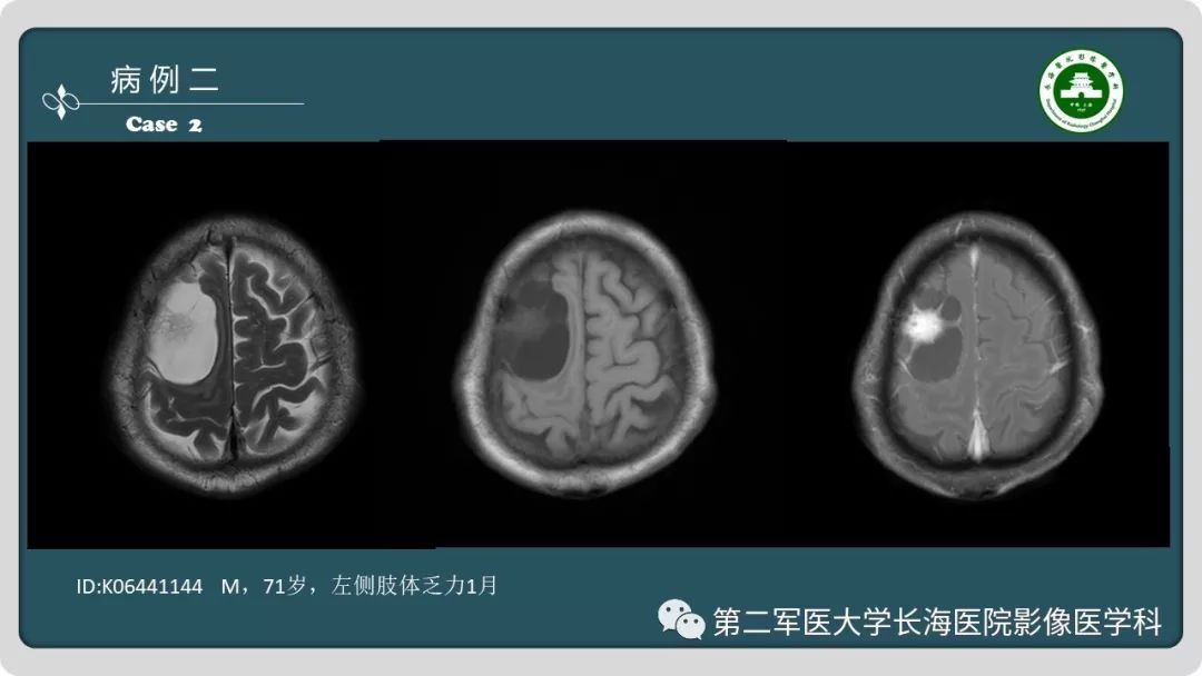影像PPT - 【PPT】颅内囊性病变影像表现-4