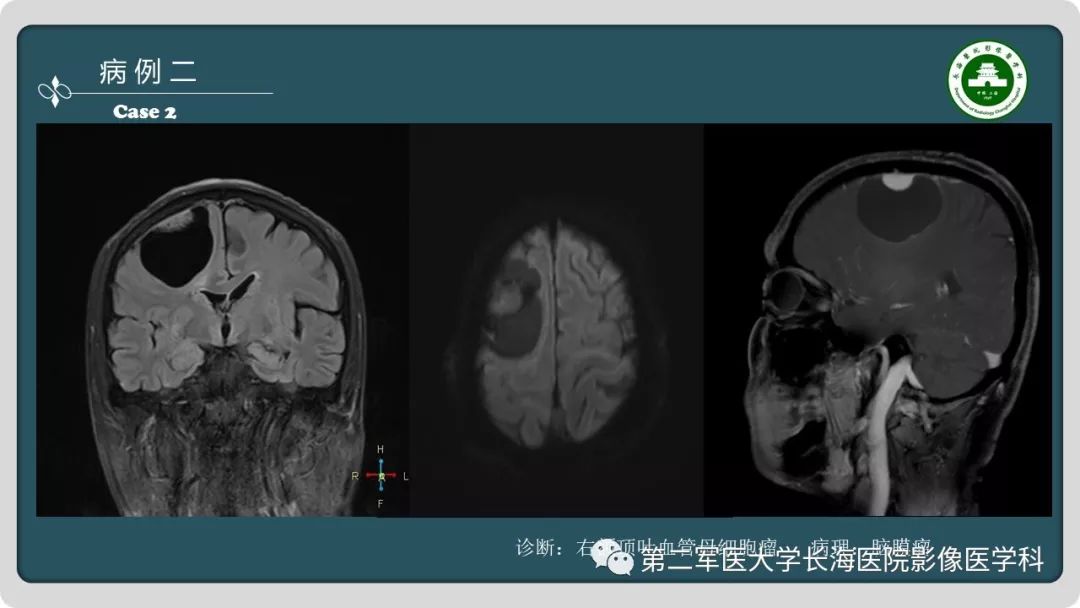 影像PPT - 【PPT】颅内囊性病变影像表现-5