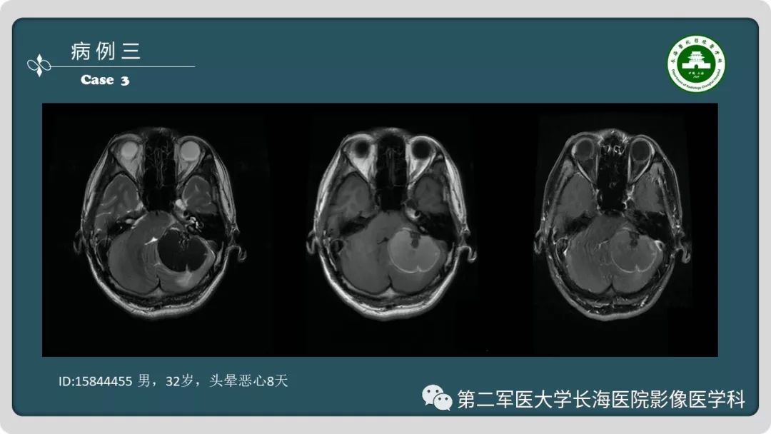 影像PPT - 【PPT】颅内囊性病变影像表现-6