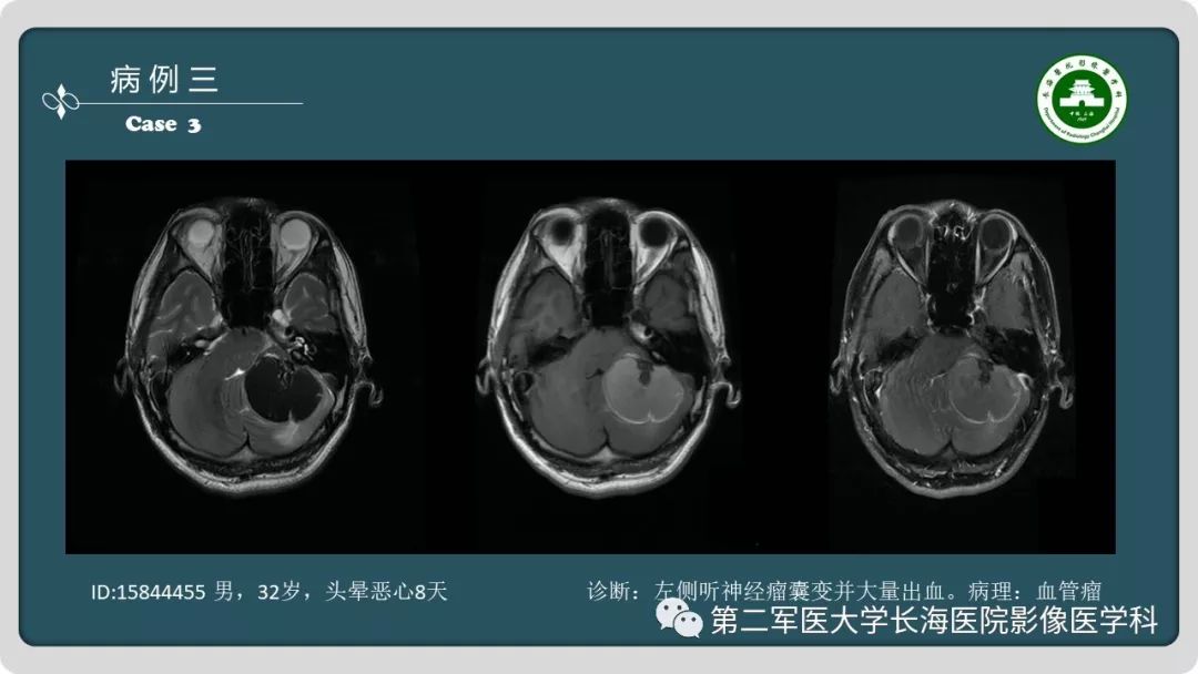 影像PPT - 【PPT】颅内囊性病变影像表现-7
