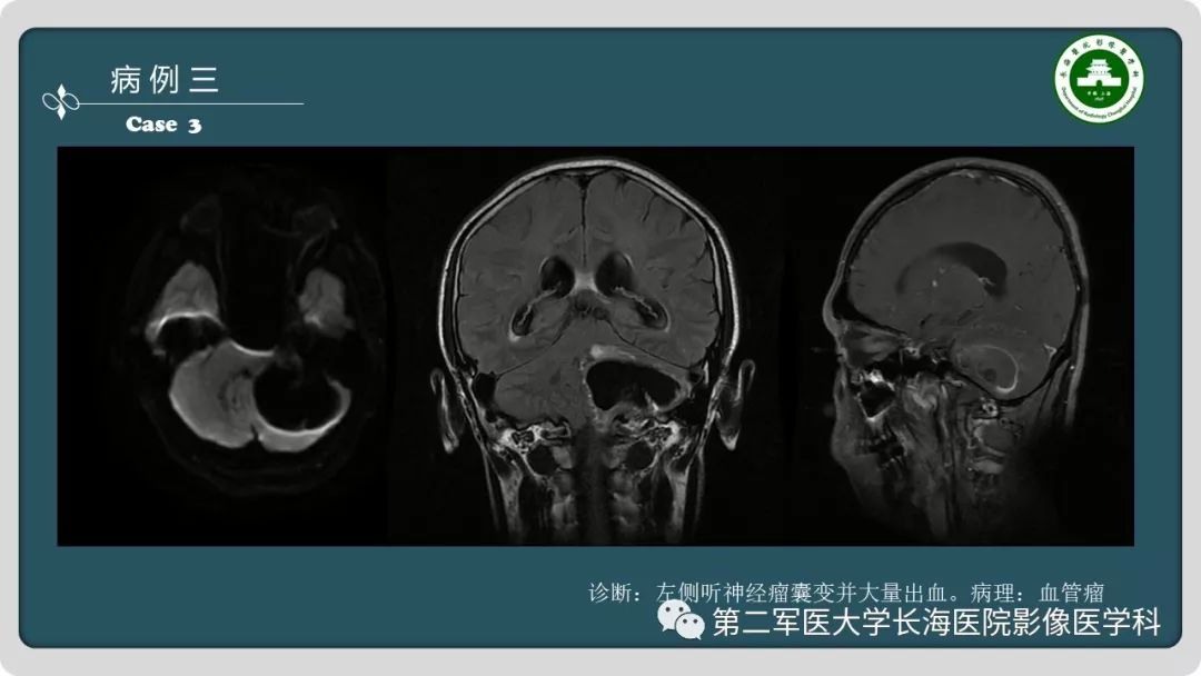 影像PPT - 【PPT】颅内囊性病变影像表现-8