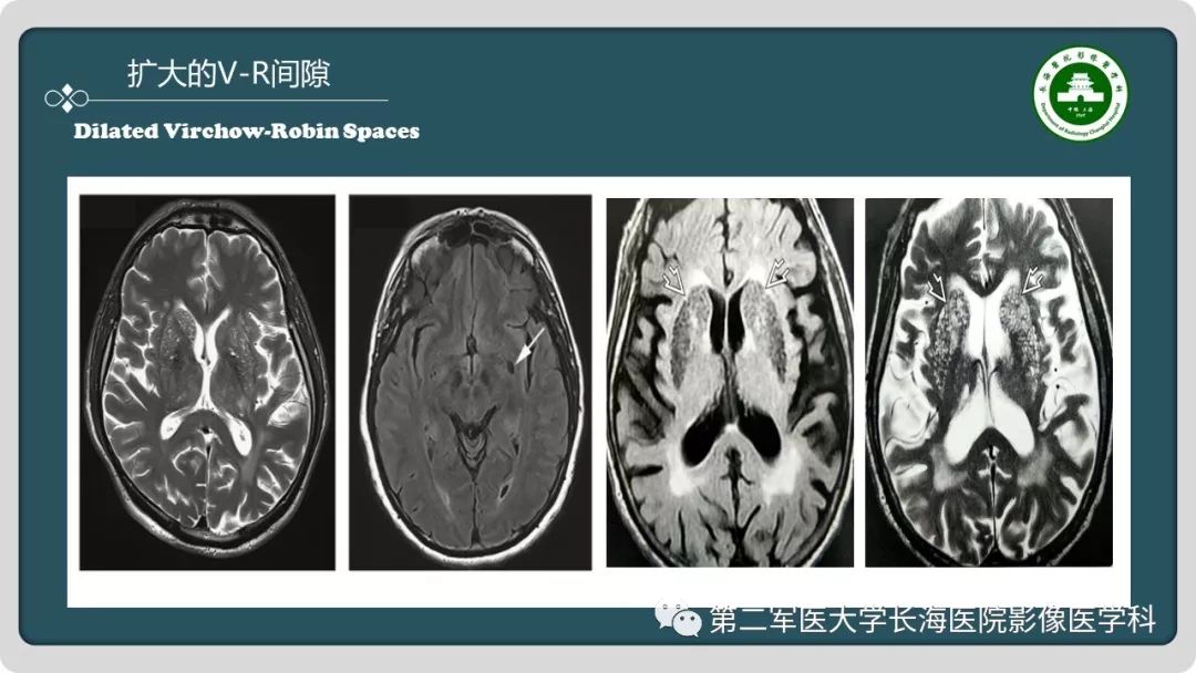 影像PPT - 【PPT】颅内囊性病变影像表现-16