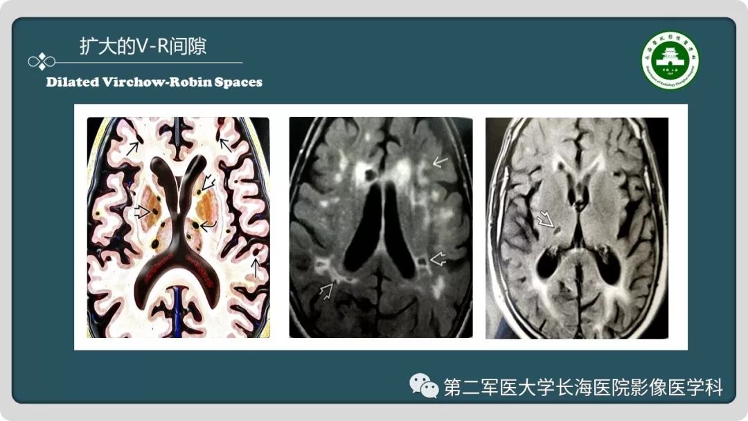 影像PPT - 【PPT】颅内囊性病变影像表现-17