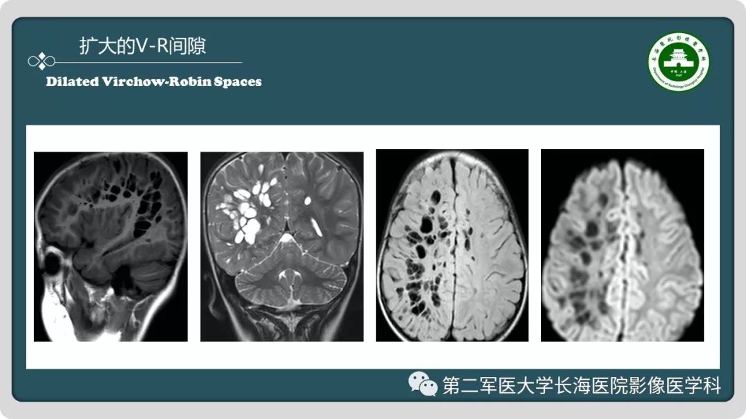 影像PPT - 【PPT】颅内囊性病变影像表现-18