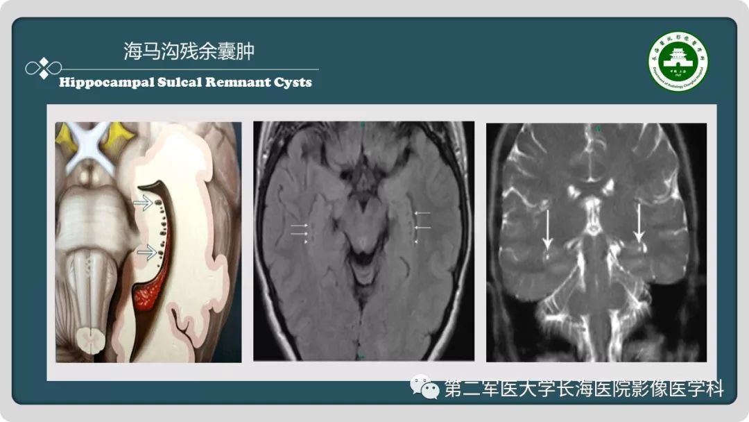 影像PPT - 【PPT】颅内囊性病变影像表现-20