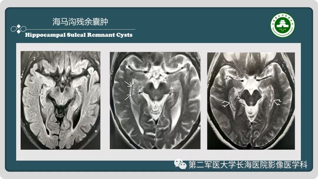 影像PPT - 【PPT】颅内囊性病变影像表现-21