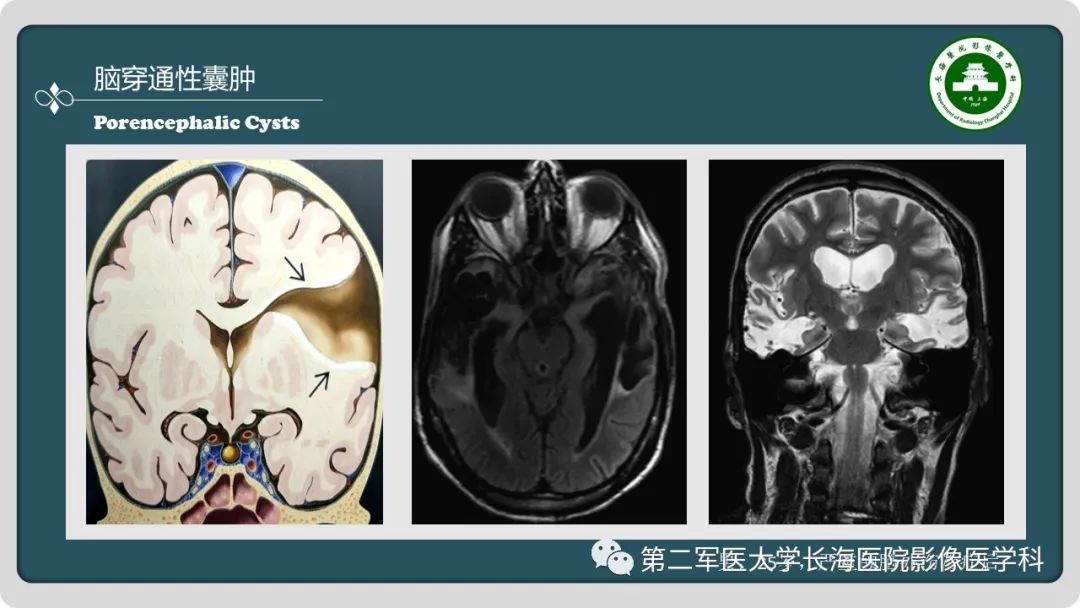 影像PPT - 【PPT】颅内囊性病变影像表现-23