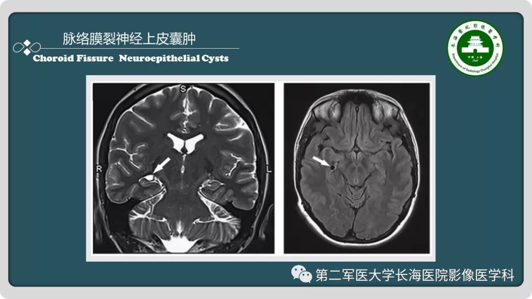 影像PPT - 【PPT】颅内囊性病变影像表现-26