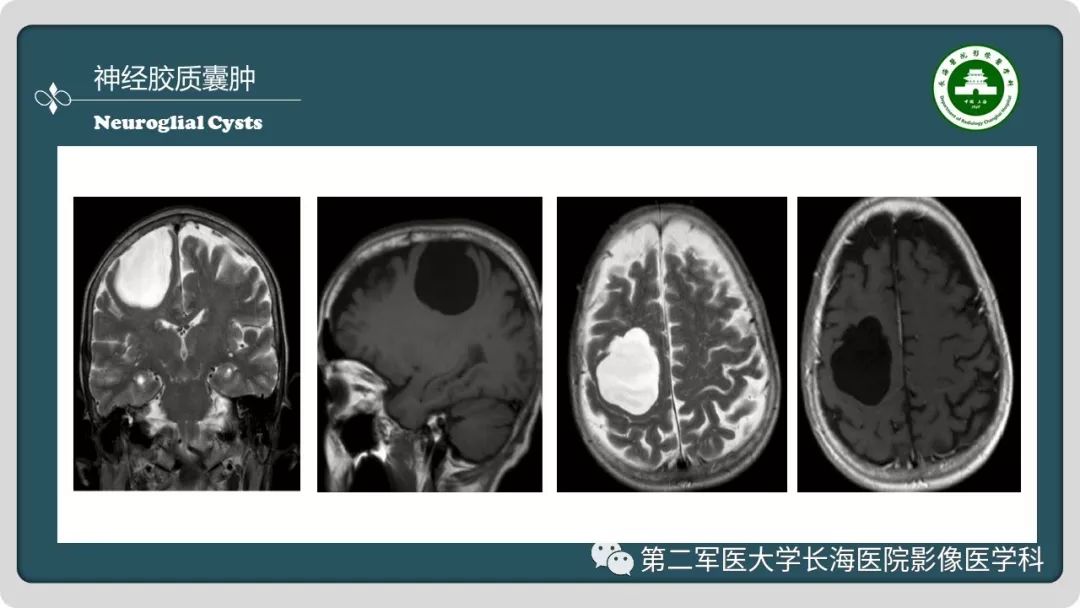 影像PPT - 【PPT】颅内囊性病变影像表现-28