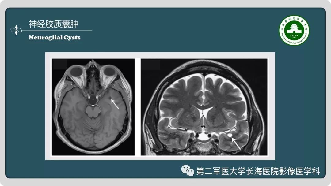 影像PPT - 【PPT】颅内囊性病变影像表现-29