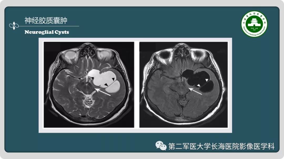 影像PPT - 【PPT】颅内囊性病变影像表现-30