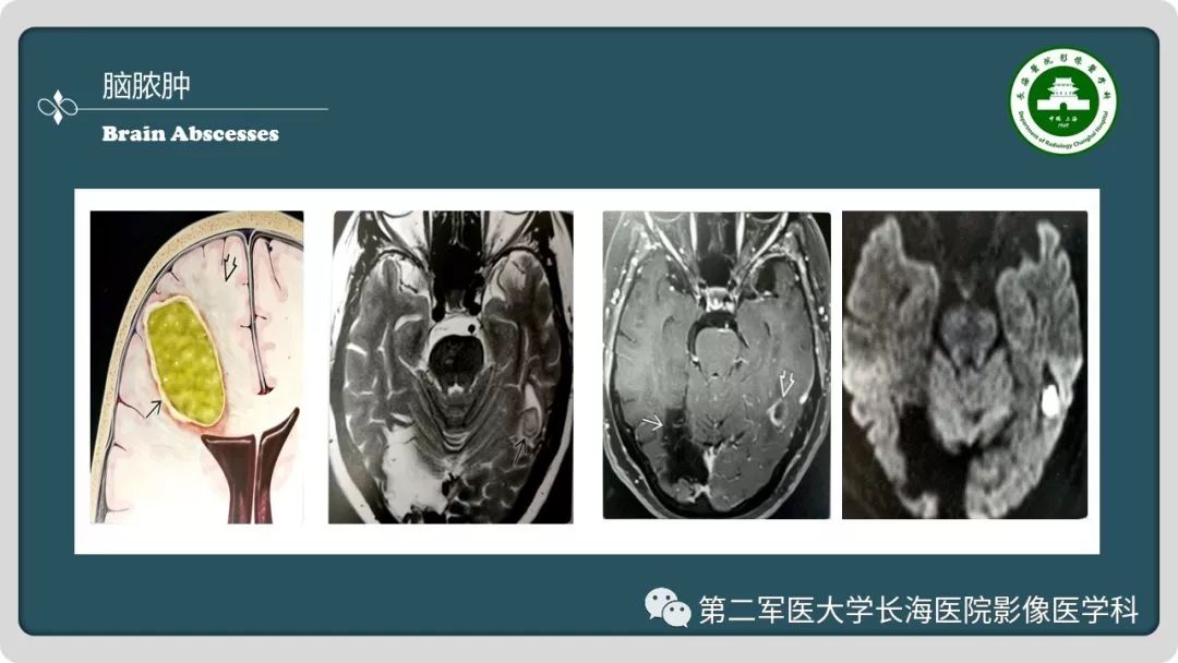 影像PPT - 【PPT】颅内囊性病变影像表现-32
