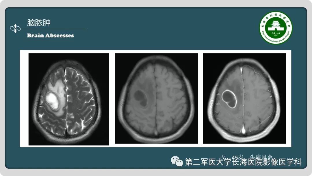 影像PPT - 【PPT】颅内囊性病变影像表现-33