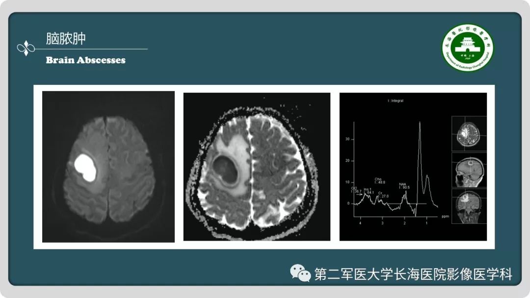 影像PPT - 【PPT】颅内囊性病变影像表现-34
