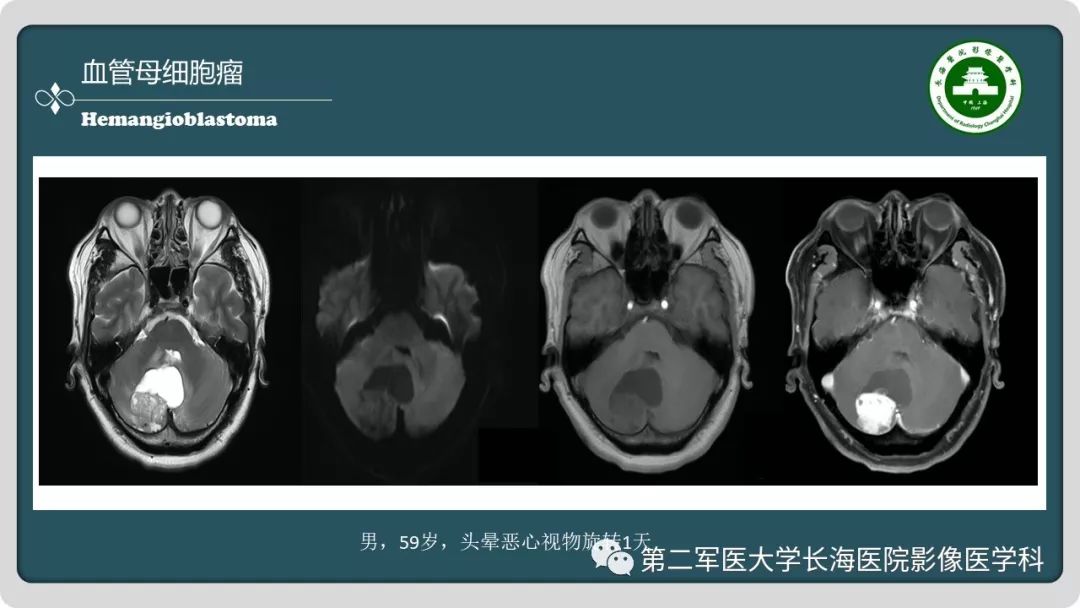 影像PPT - 【PPT】颅内囊性病变影像表现-37