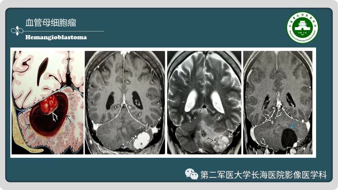 影像PPT - 【PPT】颅内囊性病变影像表现-36
