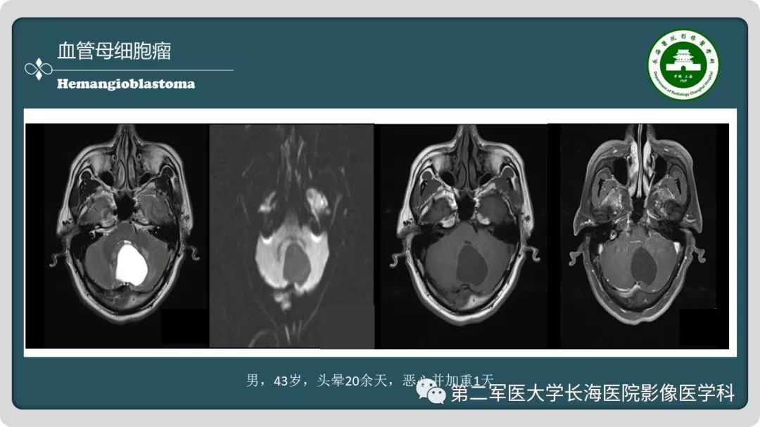 影像PPT - 【PPT】颅内囊性病变影像表现-38