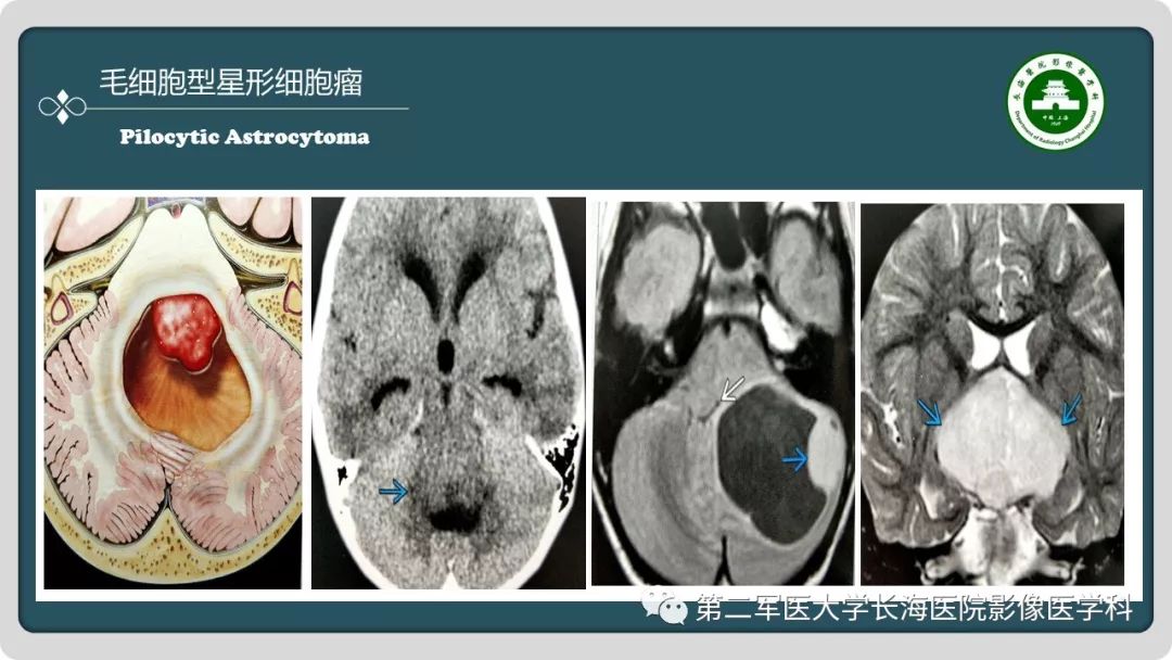 影像PPT - 【PPT】颅内囊性病变影像表现-40