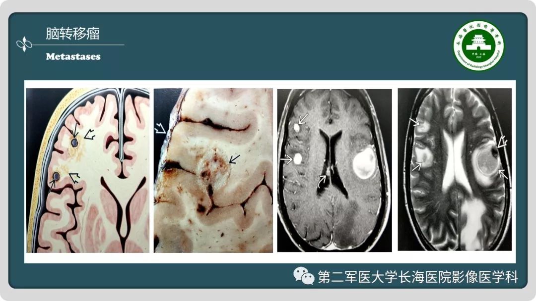 影像PPT - 【PPT】颅内囊性病变影像表现-43