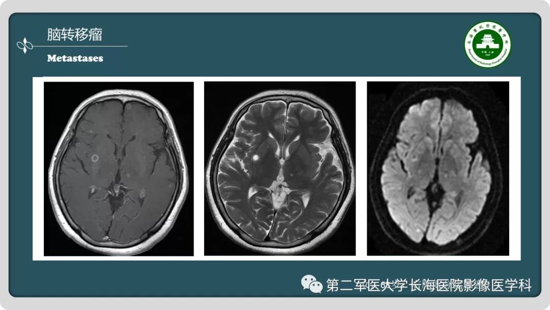 影像PPT - 【PPT】颅内囊性病变影像表现-44