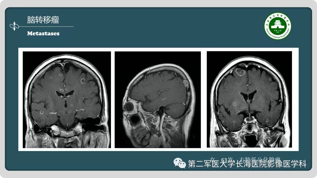 影像PPT - 【PPT】颅内囊性病变影像表现-45