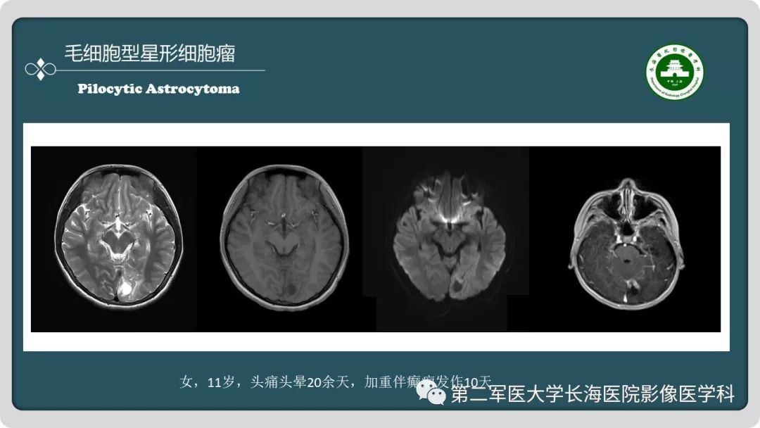 影像PPT - 【PPT】颅内囊性病变影像表现-41