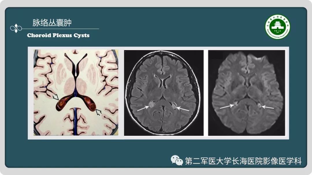 影像PPT - 【PPT】颅内囊性病变影像表现-48