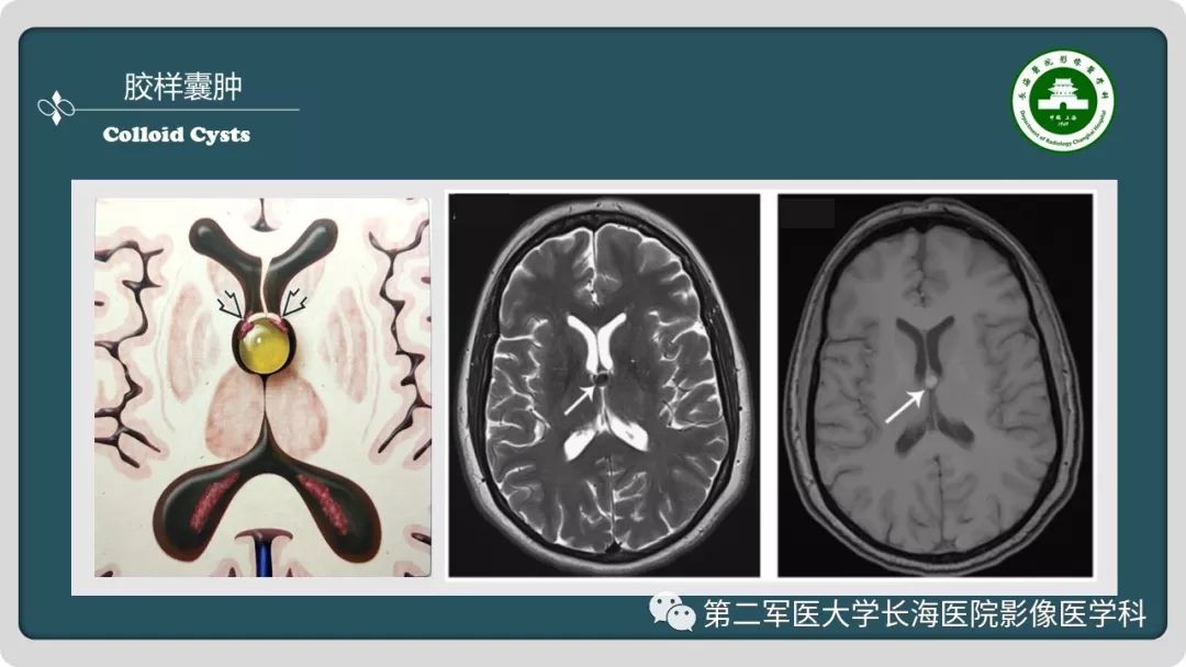 影像PPT - 【PPT】颅内囊性病变影像表现-52
