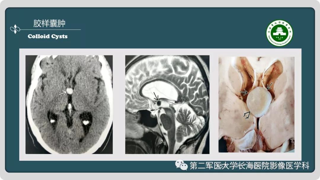 影像PPT - 【PPT】颅内囊性病变影像表现-53