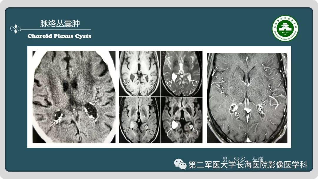 影像PPT - 【PPT】颅内囊性病变影像表现-49