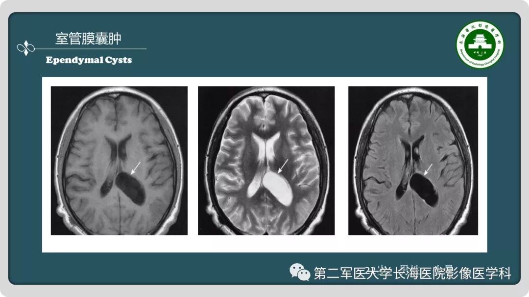 影像PPT - 【PPT】颅内囊性病变影像表现-50