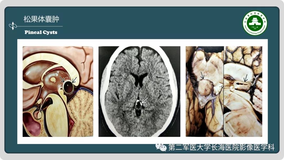 影像PPT - 【PPT】颅内囊性病变影像表现-56