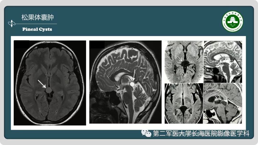 影像PPT - 【PPT】颅内囊性病变影像表现-57