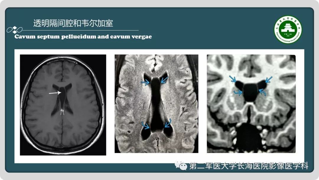 影像PPT - 【PPT】颅内囊性病变影像表现-60
